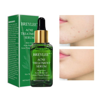 BREYLEE 17ml Tea Tree Acne Treatment Face Serum Scar Remover